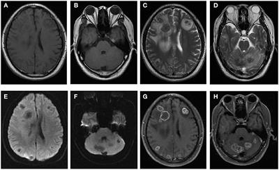 Case Report: Diagnosis of Human Alveolar Echinococcosis via Next-Generation Sequencing Analysis